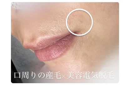 口周り産毛の脱毛