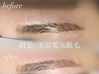 眉の脱毛